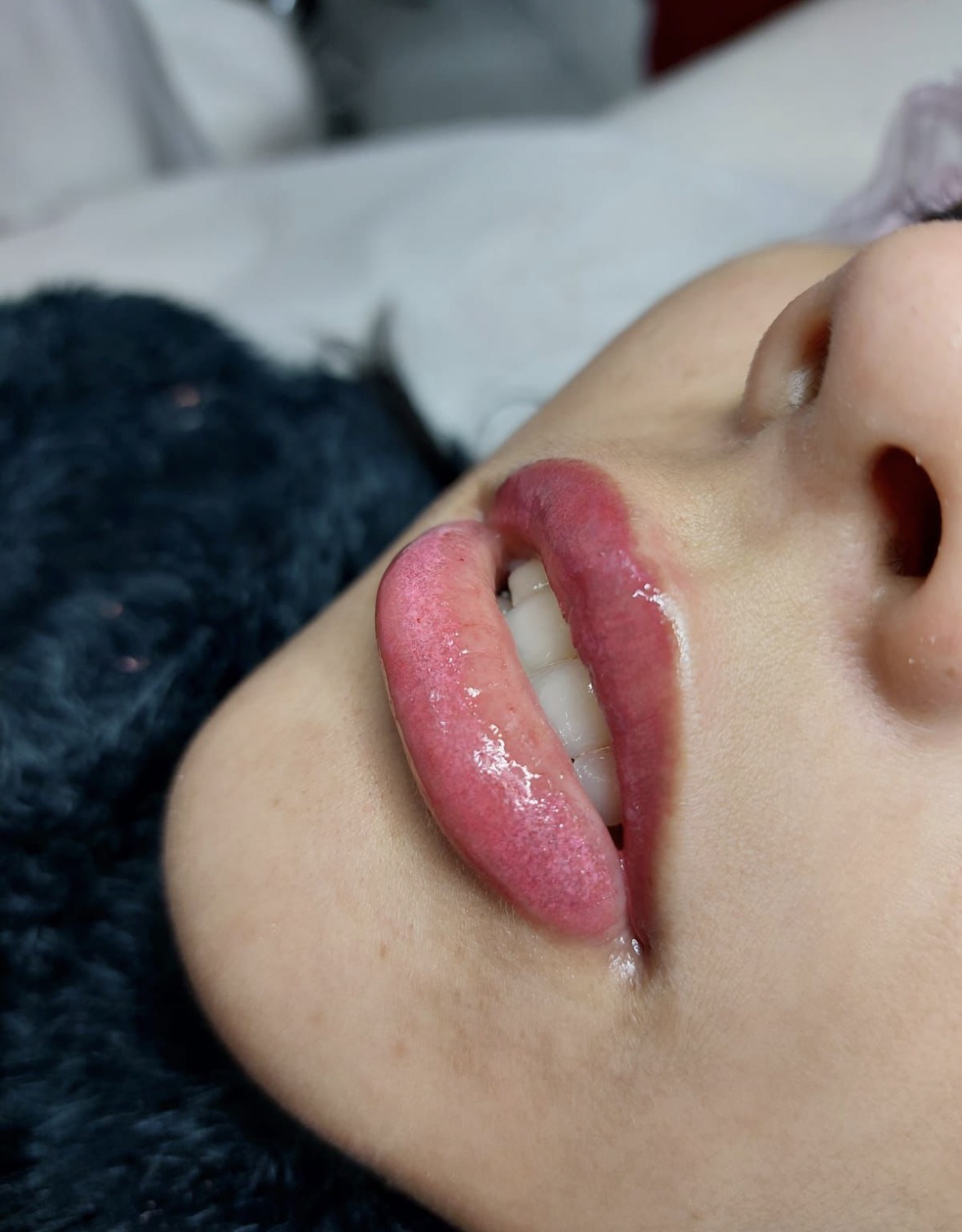 Lábios naturais e saudáveis, revitalização labial no Tatuapé