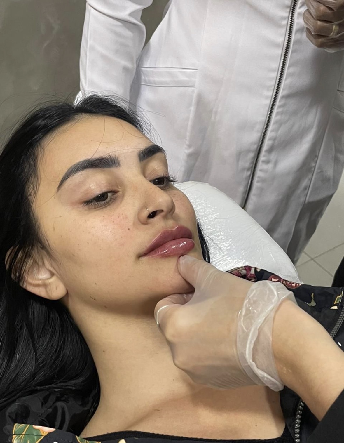 Preenchimento labial natural no Tatuapé