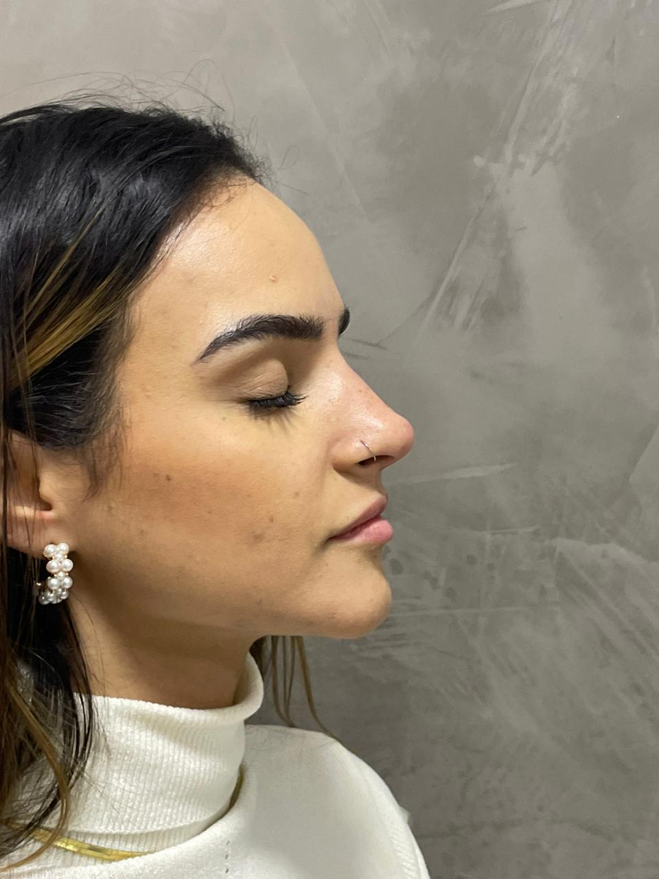 Rinomodelação e perfil nasal harmonizado no Tatuapé, São Paulo, sem cirurgia