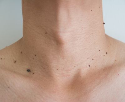 Jato de plasma para remoção de verrugas e pequenas lesões na pele no Tatuapé